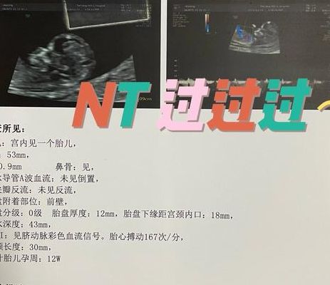 做nt一次成功妙招：别瞎爬楼梯，这3个准备才是宝宝配合的关键