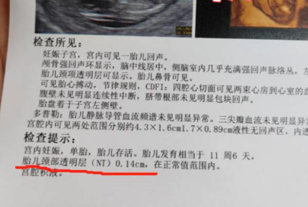 nt值无法判断胎儿性别