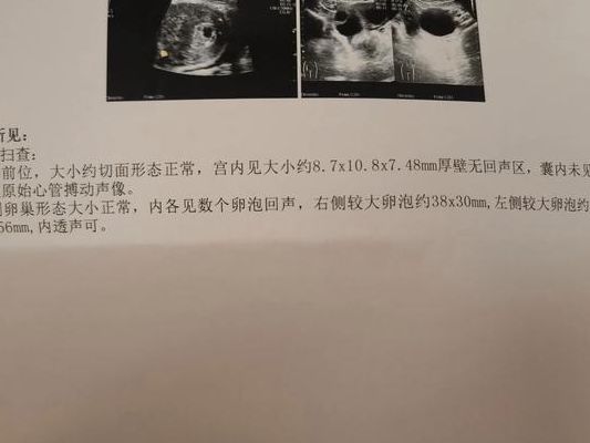 42岁4个卵泡做试管的成功率不高，但我还是等到了胎心