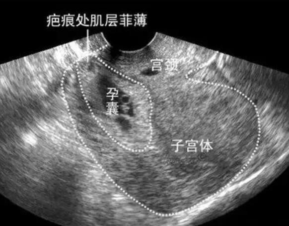 疤痕子宫不适合双胎移植