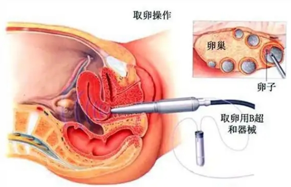 北京试管取卵不是全麻
