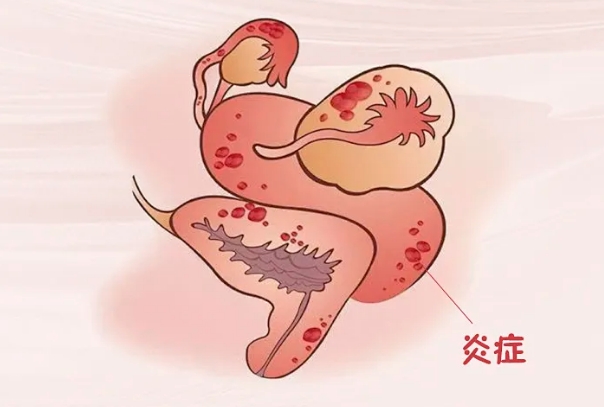 输卵管炎症怎么治疗，科学应对盆腔的隐形危机