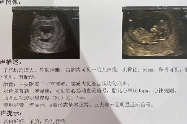 请问怀孕12周做nt检查后发现不达标的人多不多？