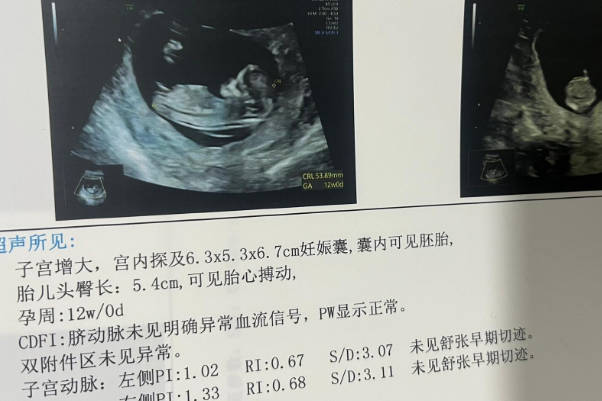 孕妇用nt报告单看生男孩还是生女孩的准确率是多少呢？