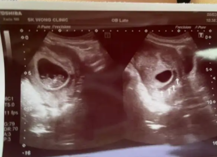 7周已见胎心但是孕囊偏小1.png