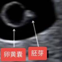 移植囊胚30天未见卵黄囊和胚芽：原因与应对