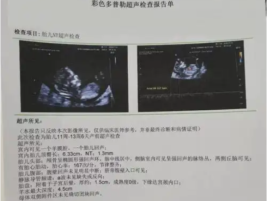 nt检查主要看胎儿颈后透明层厚度