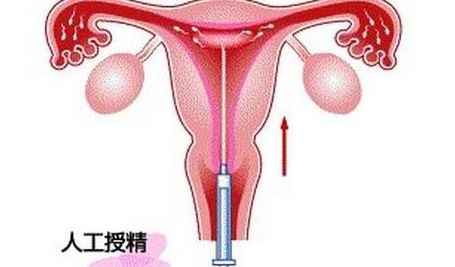 什么是人工受精什么是试管婴儿？两者区别一次讲清