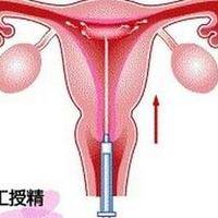 什么是人工受精什么是试管婴儿？两者区别一次讲清