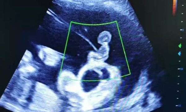 16周做唐筛跟18周区别