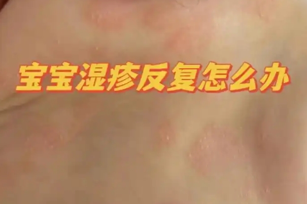新生儿湿疹是一片红的症状