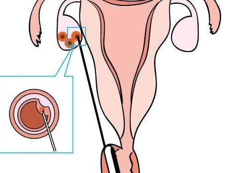 女性试管婴儿怎么做的全过程？一文讲透每个环节