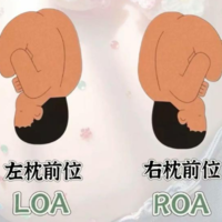 ROP胎位是什么意思？准妈妈全面指南