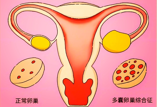 多囊食谱月减16斤