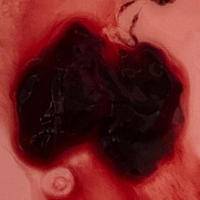 血块包含着孕囊图片，识别早期妊娠流失的体征