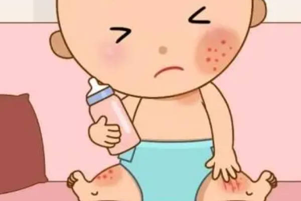 宝宝患湿疹面部会有红斑与水疱