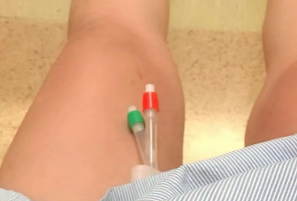 孕妇放球囊可以正常小便