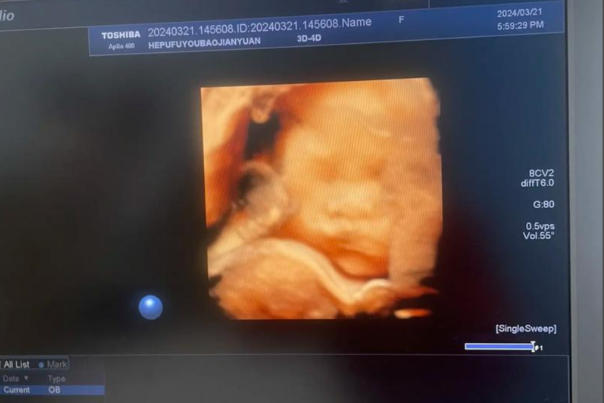 四维胎儿面孔无法判断胎儿性别
