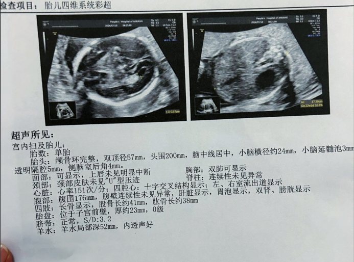 做四维检查是为了评估胎儿发育情况