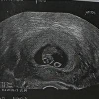 孕囊和蜕膜完整图片，为早期妊娠评估提供重要依据