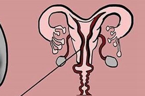 卵巢功能衰退会导致子宫萎缩