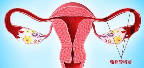 这5类女性在怀孕前请先检查输卵管，或许终身有益