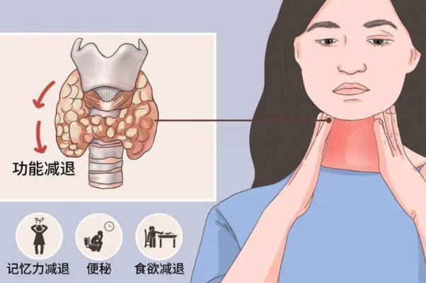 桥本甲状腺的患病率低