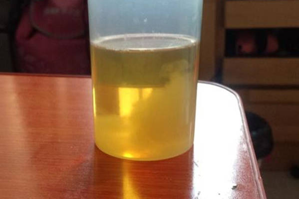 饮水量比较少会导致深黄色尿液