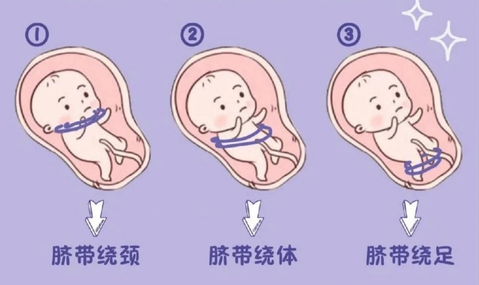 胎儿脐带绕颈绕出来