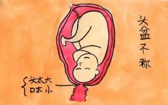 头盆不称是剖宫产指征
