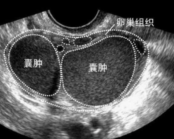 有囊肿做试管也能一次成功