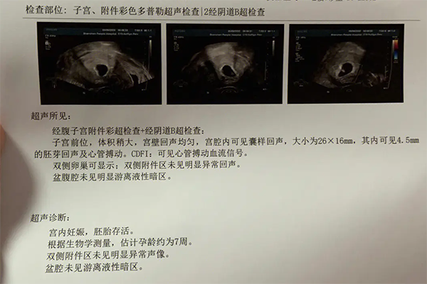 无胎心保胎成功率不大
