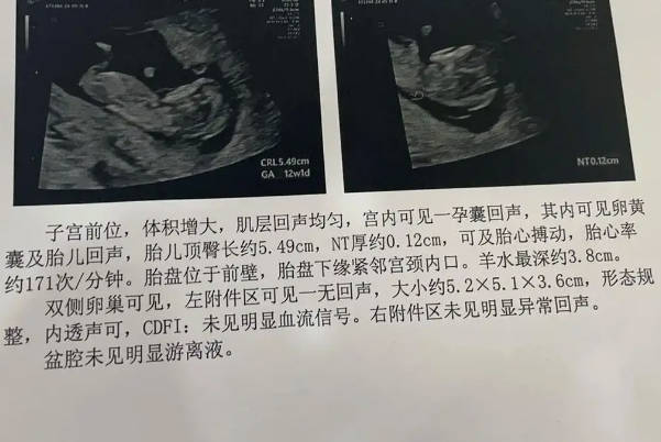 民间流传最准通过nt单子看男女宝宝的方法是怎么看的呢？