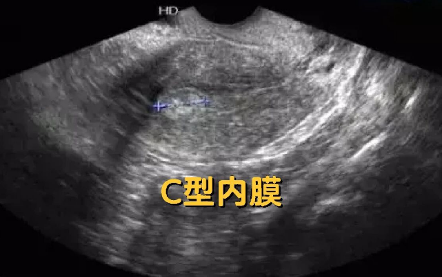 试管移植子宫内膜8c成功率