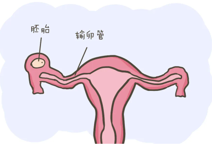 输卵管妊娠的原因.png
