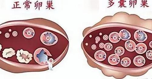 如果不排卵能做试管吗？常规促排与卵子体外成熟利弊PK