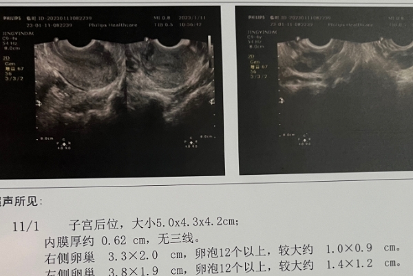 排卵监测可以提高受孕率
