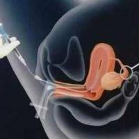 女人没有子宫能做试管吗？我折腾大半年才弄明白