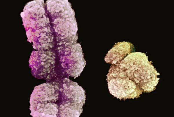 三代试管可以解决部分染色体疾病问题