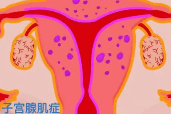 打亮丙瑞林3针一年后子宫腺肌症会复发吗？