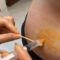 昆明送子鸟不孕医院正规吗？过来人梳理试管多少钱与6笔费用价格明细