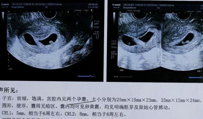 双胎试管婴儿过程亲历:两次移植失败后,她怀上了双生子