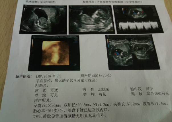 双顶径能反应胎儿发育情况