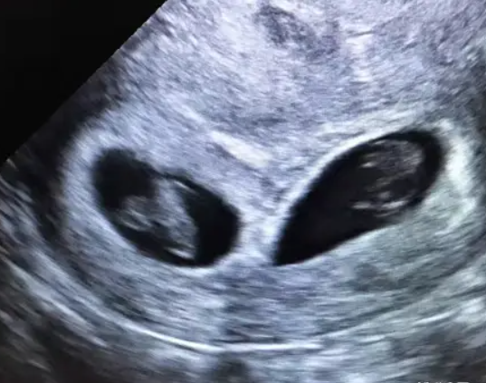多胎植入是可行的技术