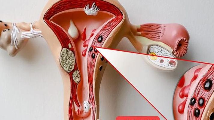 腺肌症试管用什么方案？35岁成功率高的真心话