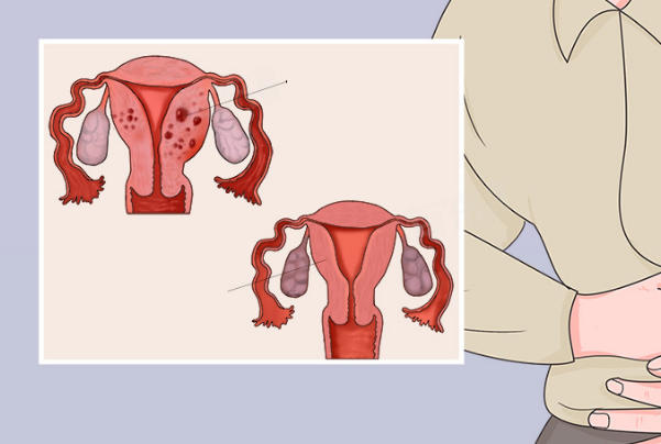 子宫畸形病情会影响治疗费用