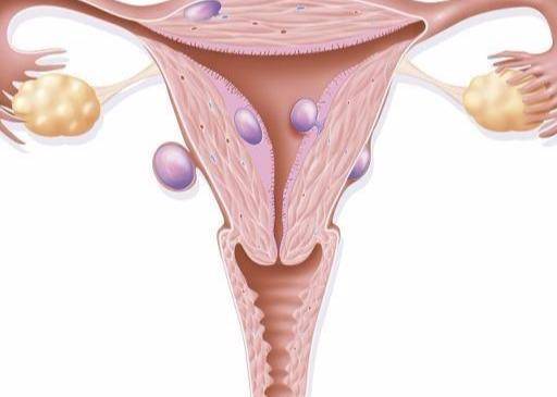 子宫内膜异位症该怎么办？能做试管婴儿吗？