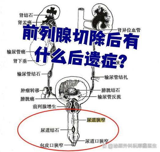 前列腺切除后还能要孩子吗，这几个生育路径你得知道