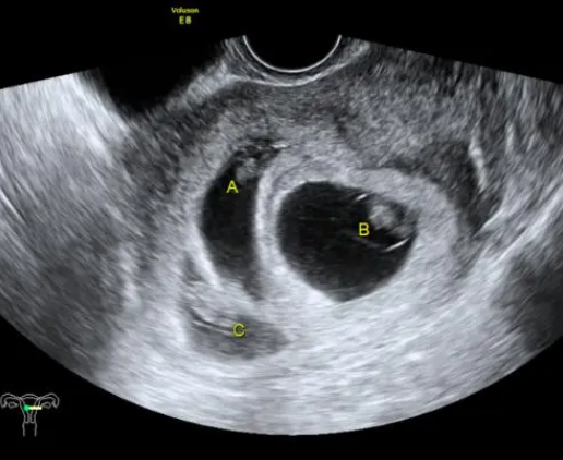 胚胎分割能实现多胎妊娠