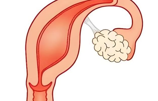 单角子宫能正常生育吗？试管费用这5笔开销明细过来人帮你梳理